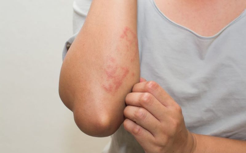 kham-pha-tac-hai-cua-cay-co-xuoc-va-tac-dung-phu-thuong-gap-2 Khám phá tác hại của cây cỏ xước và tác dụng phụ thường gặp - 2