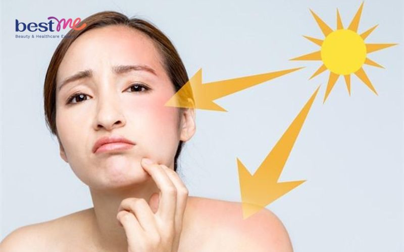 Không nên sử dụng các loại kem chống nắng không có phổ rộng