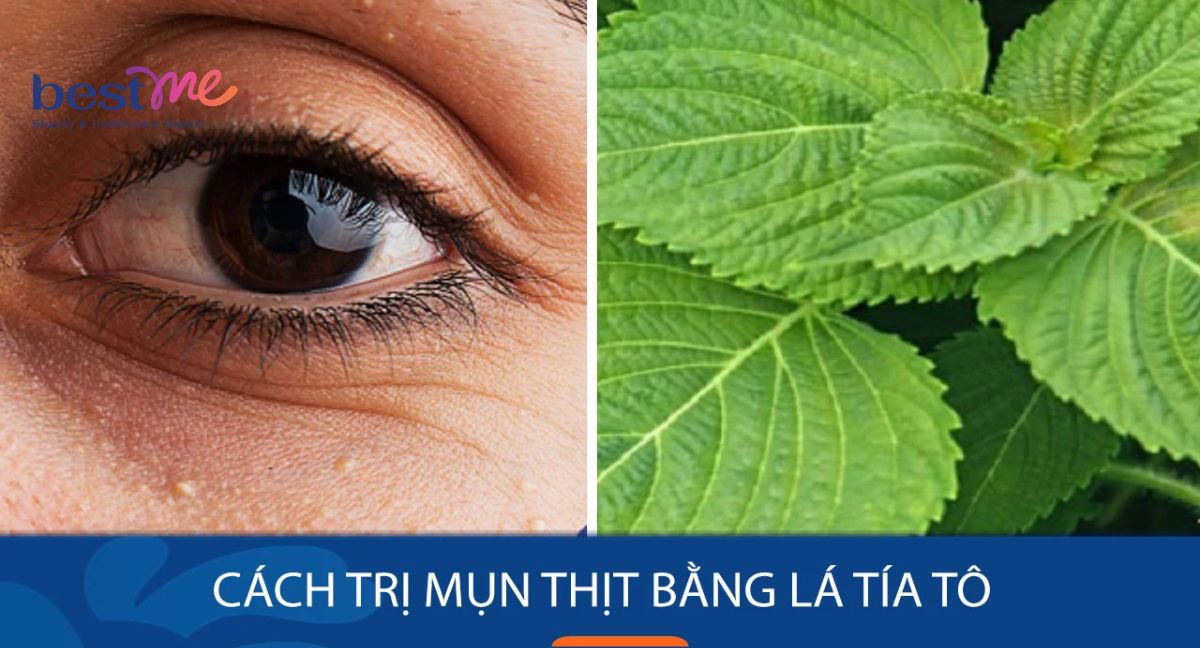 11 cách dùng lá tía tô trị mụn thịt cực dễ ngay tại nhà