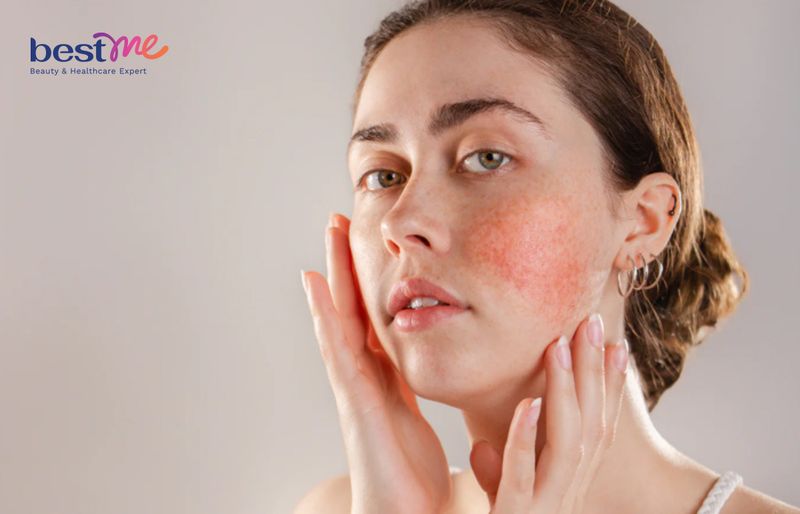 Các rủi ro tiềm ẩn khi lăn kim: kích ứng, nhiễm trùng và phản ứng dị ứng,...
