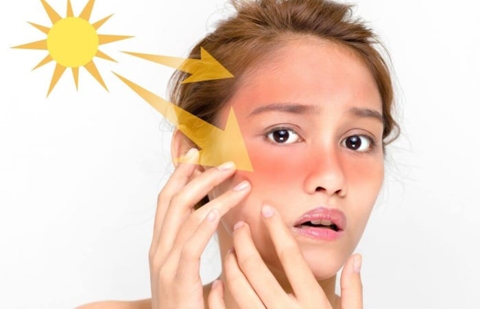 Làn da bị cháy nắng ửng đỏ có thể dùng vitamin E để làm dịu