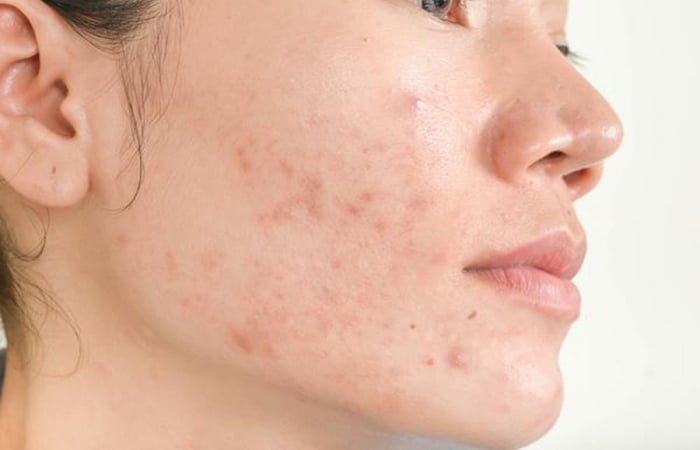 Lỗ chân lông bít tắc dần hình thành nên mụn