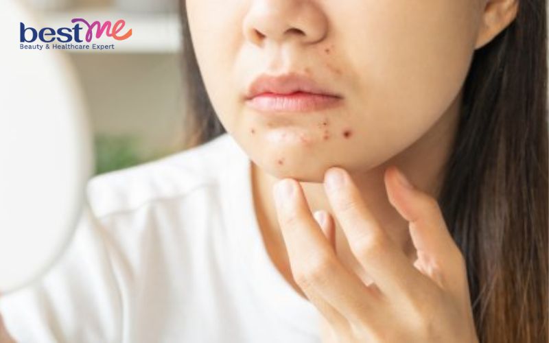 Lưu huỳnh trị mụn có tốt không? 5 sản phẩm lưu huỳnh tốt nhất - 2