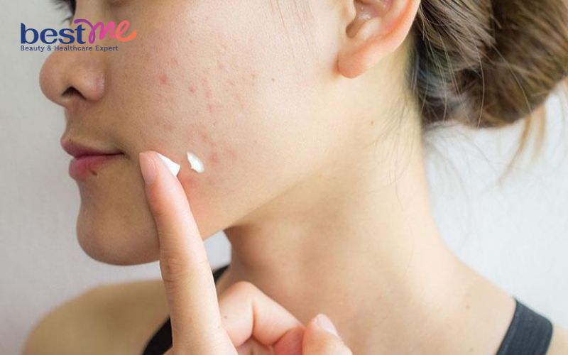 Lưu huỳnh trị mụn có tốt không? 5 sản phẩm lưu huỳnh tốt nhất - 6