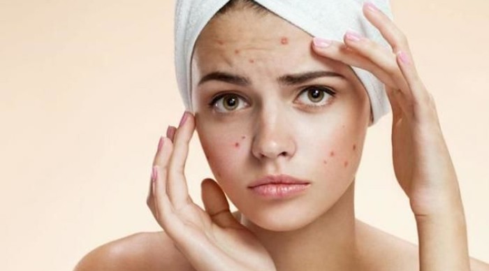 Mẹo tẩy trang bằng dầu oliu cho da nhờn giúp tránh nổi mụn