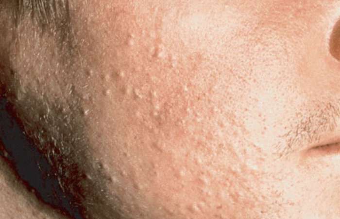 Các thành phẩm như Salicylic Acid, Glycolic, Niacinamide… thường được lựa chọn để điều trị những làn da đang gặp các vấn đề về mụn ẩn