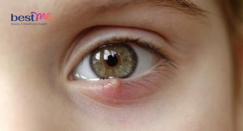 Nổi mụn nước trong mí mắt trên có nguy hiểm không?
