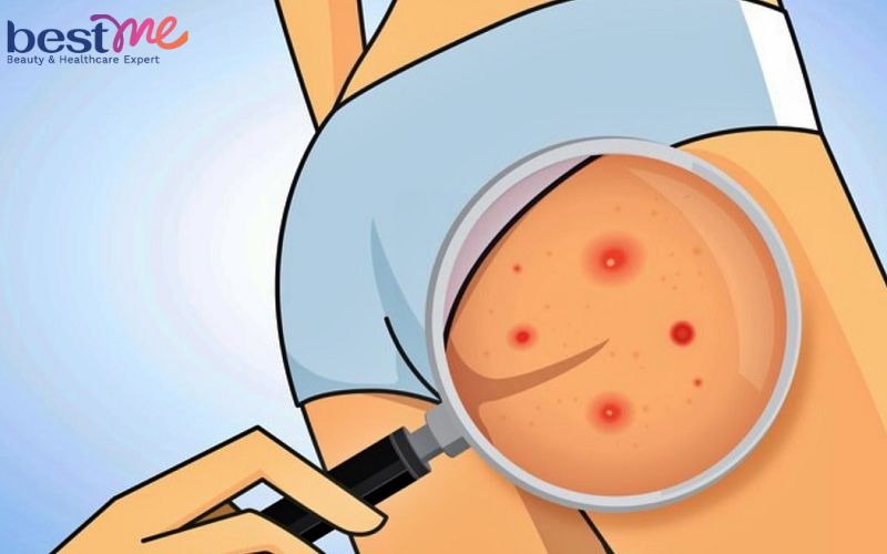 moc-mun-thit-o-mong-phai-lam-sao-cach-tri-hieu-qua-nhat-1 Mọc mụn thịt ở mông phải làm sao? Cách trị hiệu quả nhất - 1