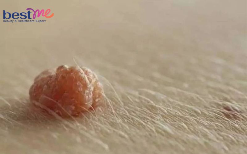 moc-mun-thit-o-mong-phai-lam-sao-cach-tri-hieu-qua-nhat-4 Mọc mụn thịt ở mông phải làm sao? Cách trị hiệu quả nhất - 4
