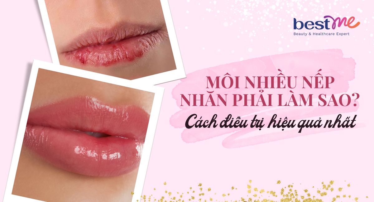 Môi nhiều nếp nhăn phải làm sao? Cách điều trị hiệu quả nhất