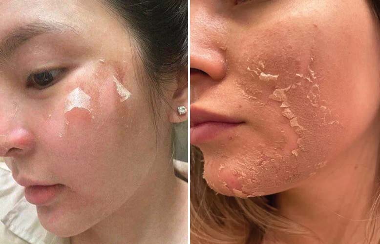 Để lớp da bong một cách tự nhiên