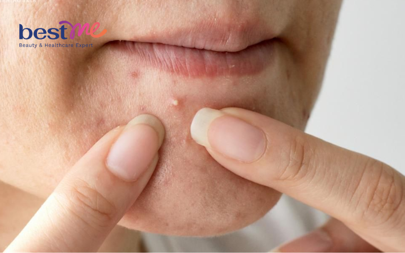 mun-an-co-nen-nan-khong-cach-nan-mun-an-tai-nha-an-toan-nhat-3 Mụn ẩn có nên nặn không? Cách nặn mụn ẩn tại nhà an toàn nhất - 3