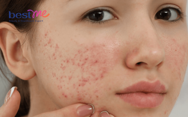 mun-an-o-ma-nguyen-nhan-va-cach-tri-triet-de-hieu-qua-nhat-1 Mụn ẩn ở má: Nguyên nhân và cách trị triệt để hiệu quả nhất - 1