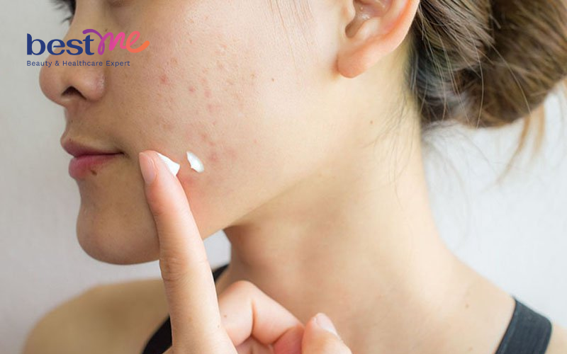 mun-an-o-ma-nguyen-nhan-va-cach-tri-triet-de-hieu-qua-nhat-7 Mụn ẩn ở má: Nguyên nhân và cách trị triệt để hiệu quả nhất - 7