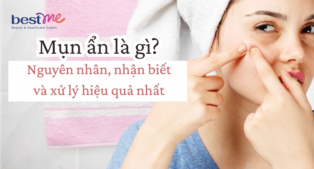 Mụn ẩn là gì? Nguyên nhân bị và cách xử lý nhanh hết nhất