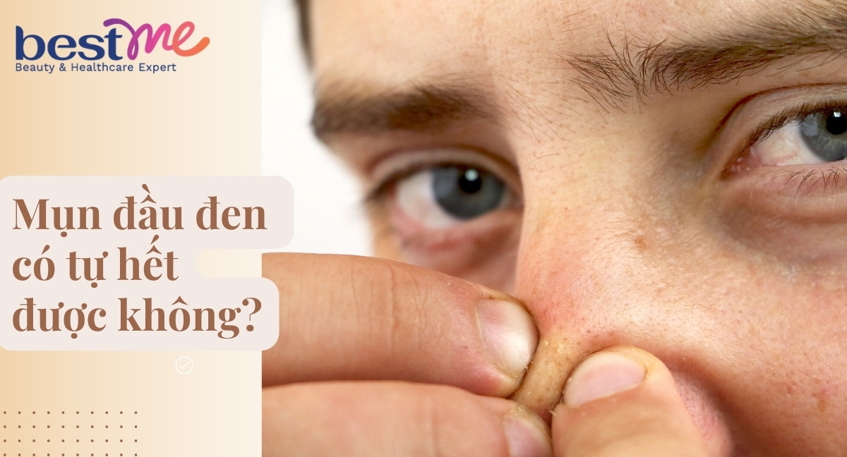 Mụn đầu đen có tự hết được không? Để lâu có sao không?