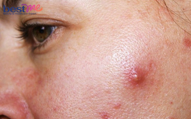 mun-boc-co-nen-nan-khong-cach-nan-mun-boc-khong-tham-seo-1 Mụn bọc có nên nặn không? Cách nặn mụn bọc không thâm, sẹo - 1