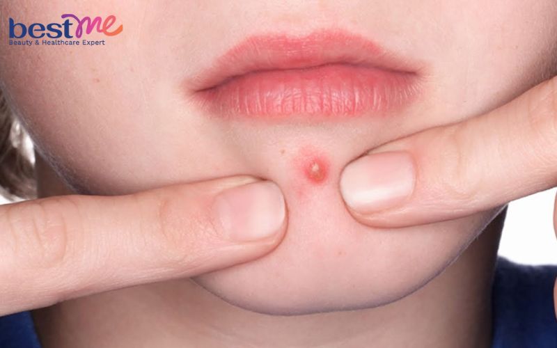 mun-boc-co-nen-nan-khong-cach-nan-mun-boc-khong-tham-seo-10 Mụn bọc có nên nặn không? Cách nặn mụn bọc không thâm, sẹo - 10
