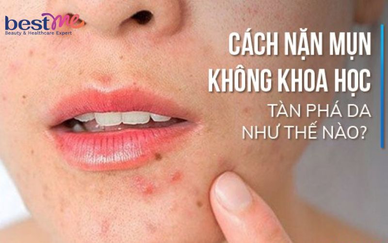mun-boc-co-nen-nan-khong-cach-nan-mun-boc-khong-tham-seo-3 Mụn bọc có nên nặn không? Cách nặn mụn bọc không thâm, sẹo - 3