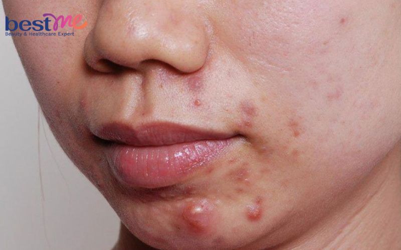 mun-boc-co-nen-nan-khong-cach-nan-mun-boc-khong-tham-seo-4 Mụn bọc có nên nặn không? Cách nặn mụn bọc không thâm, sẹo - 4