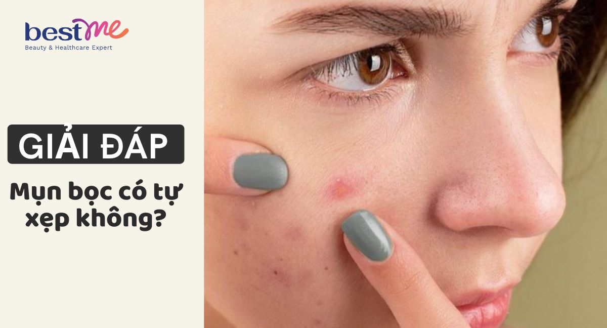 Giải đáp: Mụn bọc có tự xẹp không? Không nặn có tự hết?