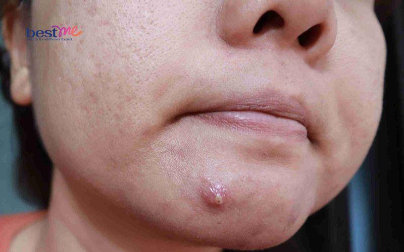 mun-boc-mu-co-nen-nan-khong-he-lo-cach-dieu-tri-nhanh-nhat-1 Mụn bọc mủ có nên nặn không? Hé lộ cách điều trị nhanh nhất - 1