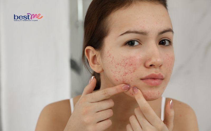 mun-boc-mu-co-nen-nan-khong-he-lo-cach-dieu-tri-nhanh-nhat-3 Mụn bọc mủ có nên nặn không? Hé lộ cách điều trị nhanh nhất - 3