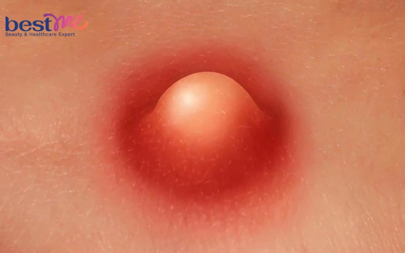 mun-boc-o-mong-phai-lam-sao-cach-chua-tri-hieu-qua-nhat-4 Mụn bọc ở mông phải làm sao? Cách chữa trị hiệu quả nhất - 4