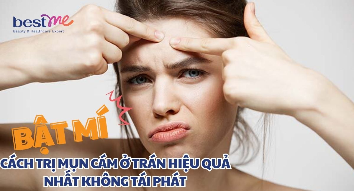 Hé lộ cách trị mụn cám ở trán nhanh nhất chuẩn chuyên gia