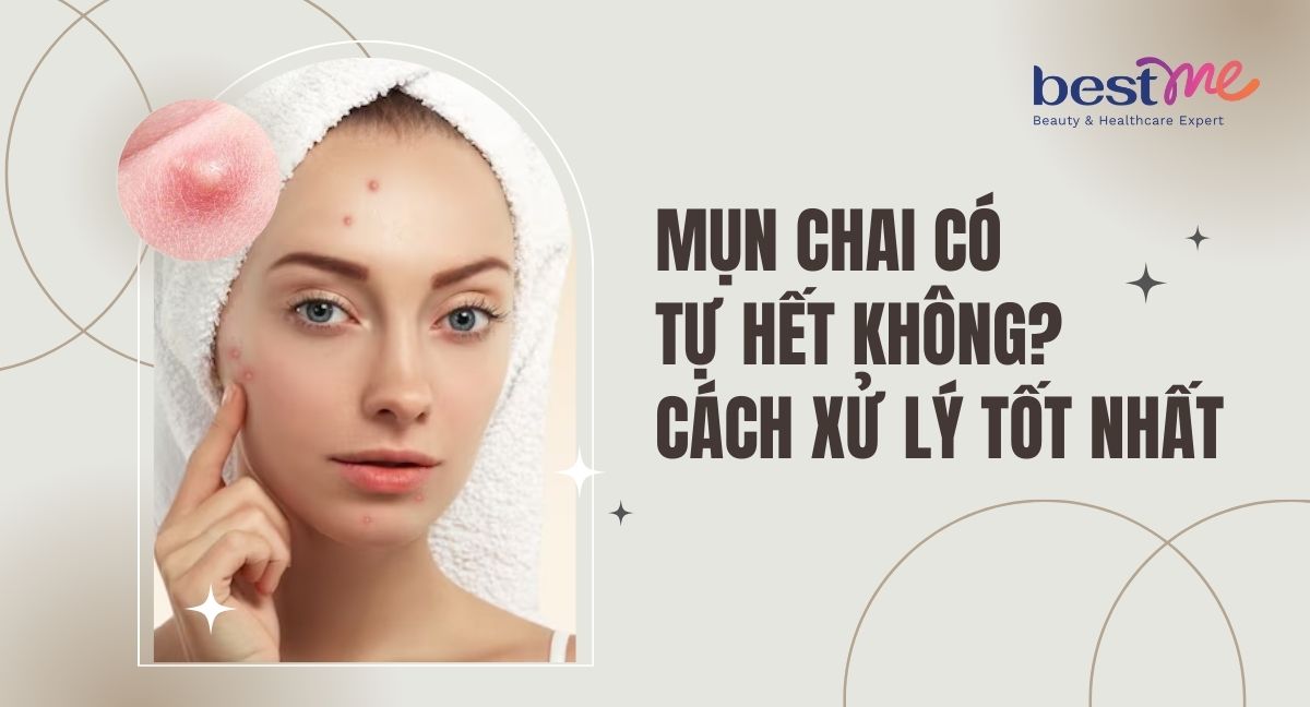 Mụn chai có tự hết không? Phải làm sao? Cách xử lý tốt nhất