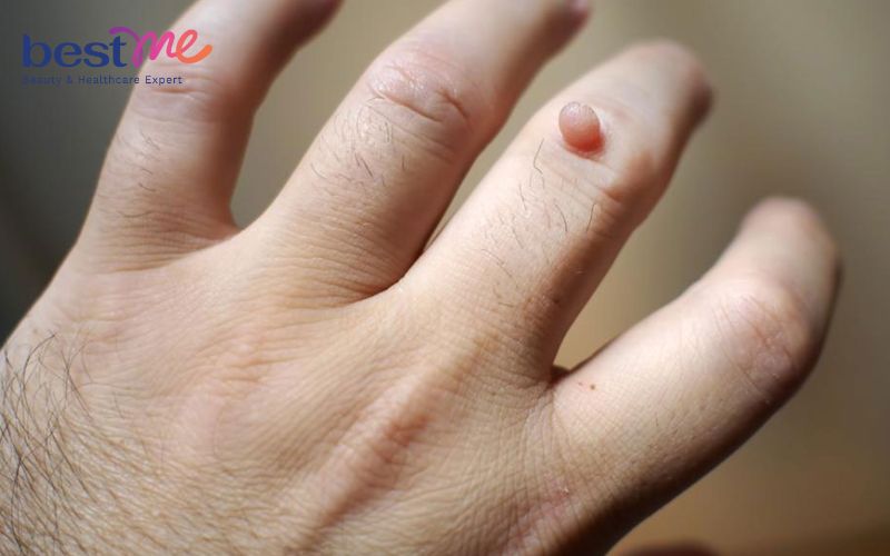 mun-coc-co-lay-khong-qua-duong-nao-cach-phong-tranh-lay-1 Mụn cóc có lây không? Qua đường nào? Cách phòng tránh lây - 1