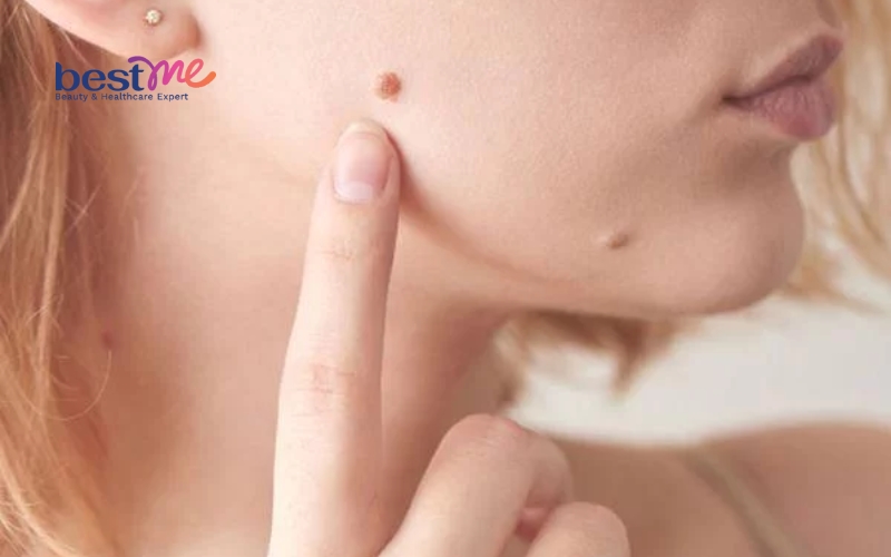 mun-coc-co-tu-het-khong-lam-sao-de-muc-coc-nhanh-rung-hon-2 Mụn cóc có tự hết không? Làm sao để mục cóc nhanh rụng hơn? - 2