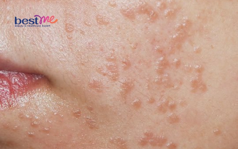 mun-coc-phang-la-gi-cach-chua-mun-coc-phang-hieu-qua-bat-ngo-1 Mụn cóc phẳng là gì? Cách chữa mụn cóc phẳng hiệu quả bất ngờ - 1