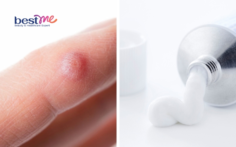 mun-coc-phang-la-gi-cach-chua-mun-coc-phang-hieu-qua-bat-ngo-7 Mụn cóc phẳng là gì? Cách chữa mụn cóc phẳng hiệu quả bất ngờ - 7