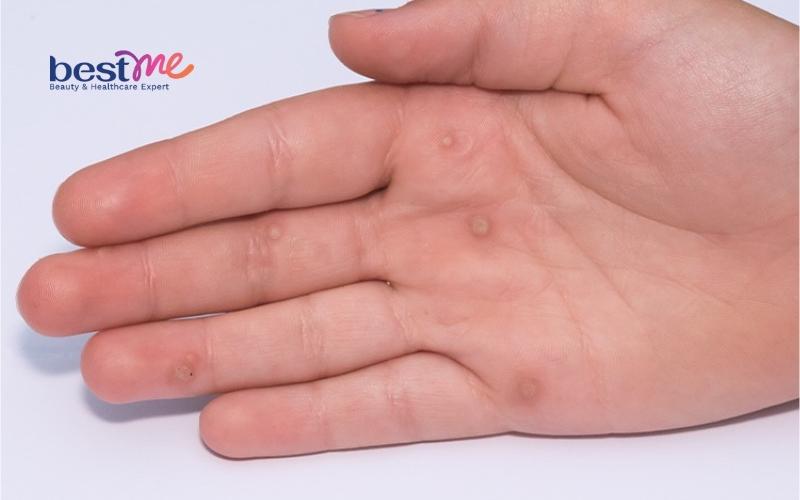 mun-com-mun-coc-o-tay-co-nguy-hiem-khong-cach-tri-nhanh-nhat-2 Mụn cơm, mụn cóc ở tay có nguy hiểm không? Cách trị nhanh nhất - 2