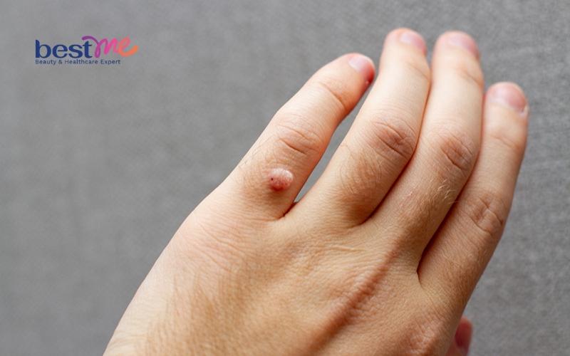 mun-com-mun-coc-o-tay-co-nguy-hiem-khong-cach-tri-nhanh-nhat-3 Mụn cơm, mụn cóc ở tay có nguy hiểm không? Cách trị nhanh nhất - 3