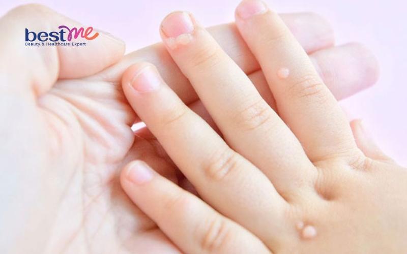Mụn cơm, mụn cóc ở trẻ em? Nguyên nhân và cách trị hiệu quả - 2