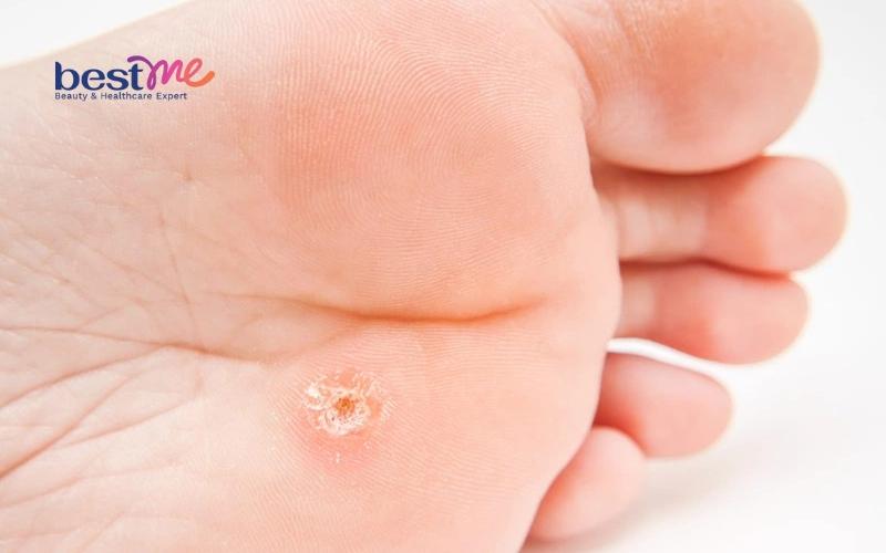 Mụn cơm, mụn cóc ở trẻ em? Nguyên nhân và cách trị hiệu quả - 3