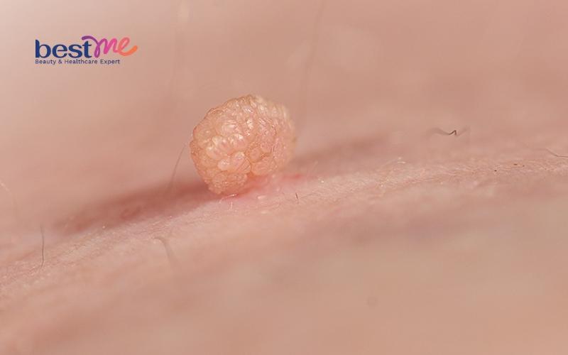 Mụn cơm, mụn cóc ở trẻ em? Nguyên nhân và cách trị hiệu quả - 4