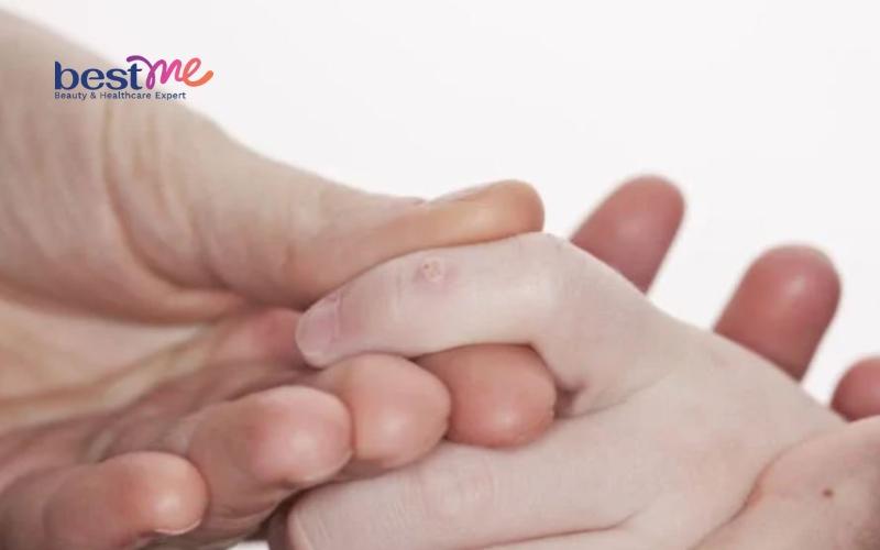 Mụn cơm, mụn cóc ở trẻ em? Nguyên nhân và cách trị hiệu quả - 5