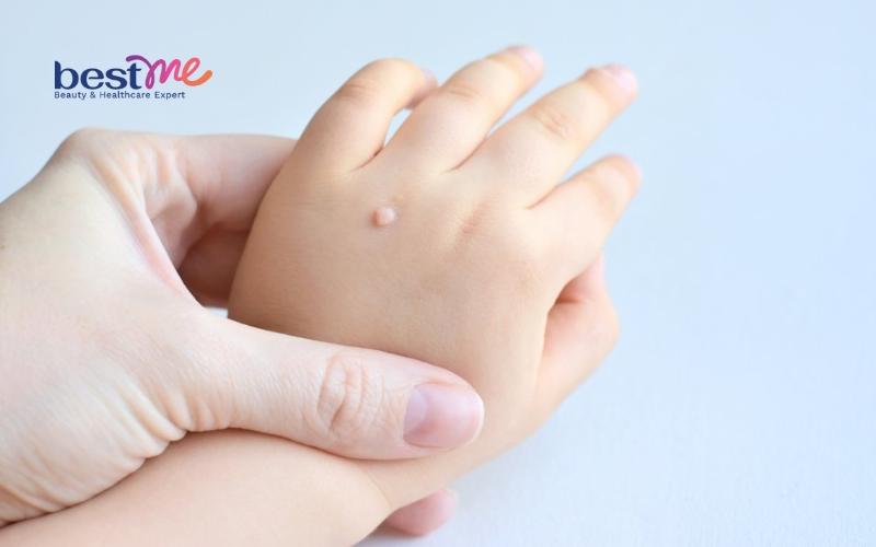 Mụn cơm, mụn cóc ở trẻ em? Nguyên nhân và cách trị hiệu quả - 6