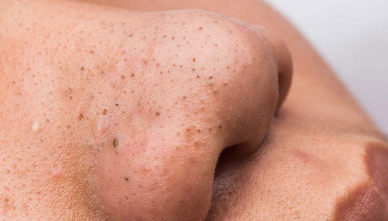 Mụn đầu đen hình thành do tuyến dầu hoạt động mạnh mẽ gây bít tắc lỗ chân lông