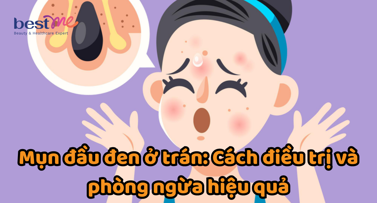 Hướng dẫn cách trị mụn đầu đen ở trán chuẩn chuyên gia