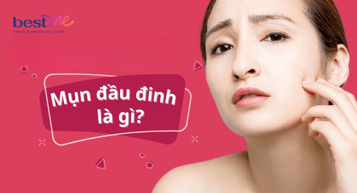 Mụn đầu đinh là gì? Có tự khỏi không? Có nguy hiểm không?