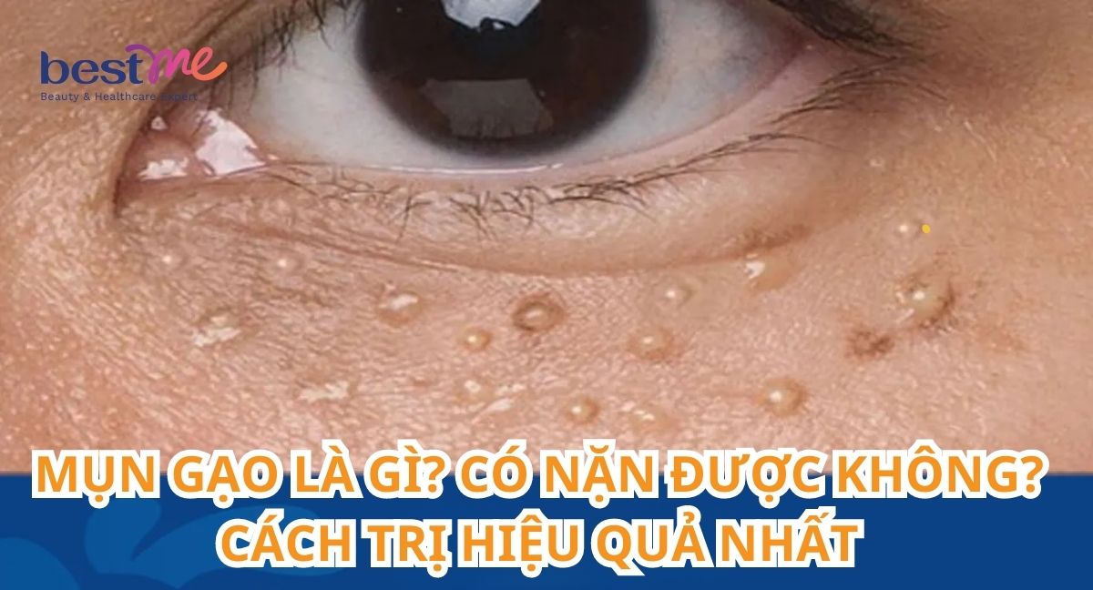 Mụn gạo là gì? Có nặn được không? Cách trị hiệu quả nhất