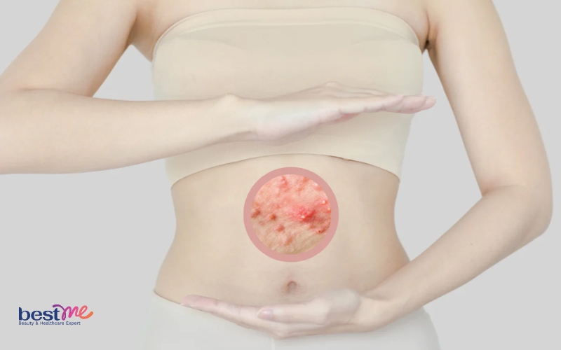 mun-mu-la-gi-co-tu-het-khong-kieng-an-gi-de-nhanh-khoi-5 Mụn mủ là gì? Có tự hết không? Kiêng ăn gì để nhanh khỏi? - 5