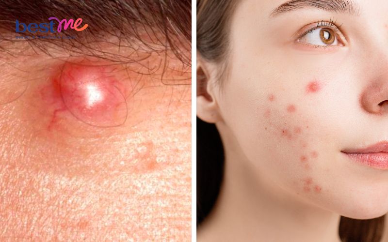 mun-nang-la-gi-co-tu-het-khong-cach-tri-hieu-qua-nhat-8 Mụn nang là gì? Có tự hết không? Cách trị hiệu quả nhất - 8