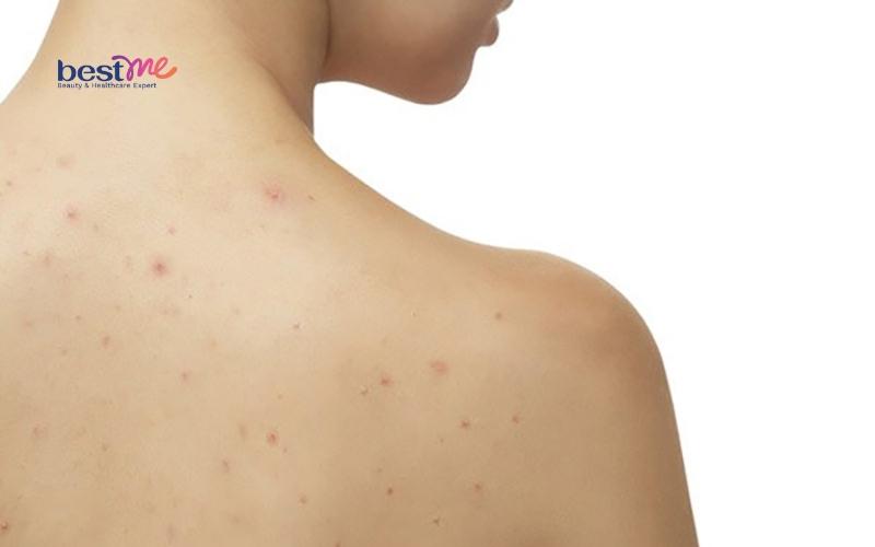 Mụn nhọt ở lưng có nguy hiểm không? Cách trị hiệu quả nhất? - 1