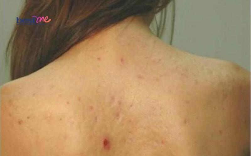 Mụn nhọt ở lưng có nguy hiểm không? Cách trị hiệu quả nhất? - 2