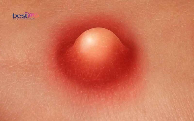 Mụn nhọt ở lưng có nguy hiểm không? Cách trị hiệu quả nhất? - 3